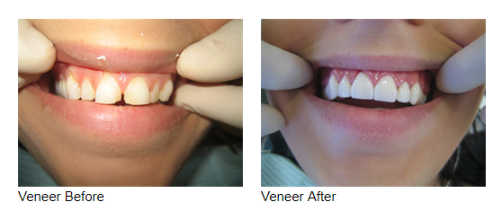 Porcelain Veneers